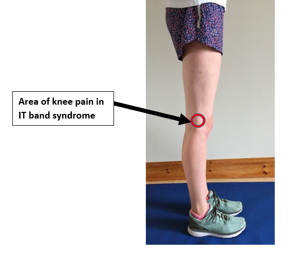 Iliotibial Band Syndrome  Diagnosis & Treatment for Physios